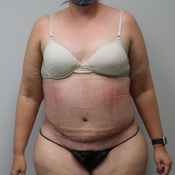 after tummy tuck in nashville female patient front view view case 613