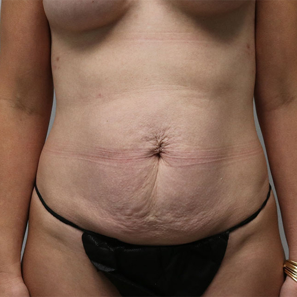 before tummy tuck female patient front view view case 619
