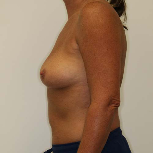 Before Breast Augmentation Female Patient L Side Angle View Case 984