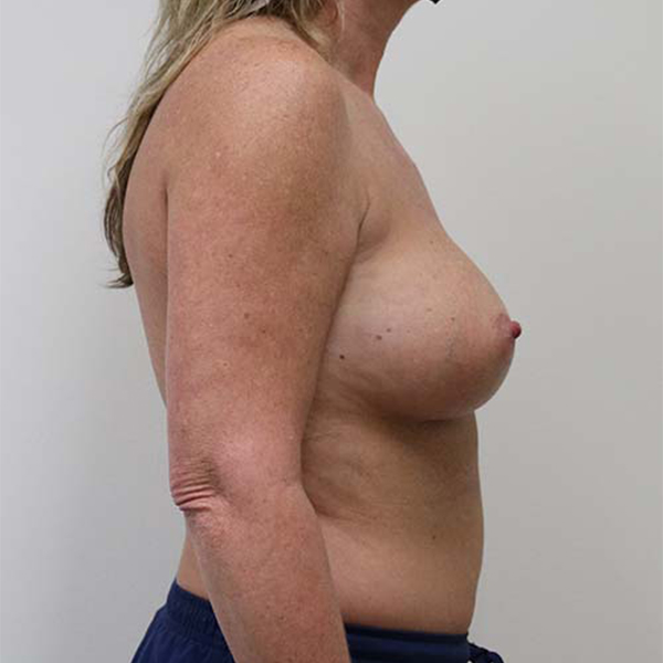 After Breast Augmentation Female Patient R Side Angle View Case 984