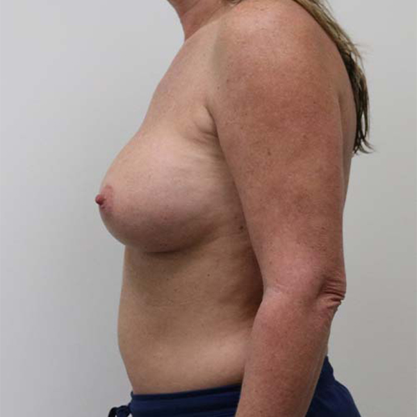 After Breast Augmentation Female Patient L Side Angle View Case 984