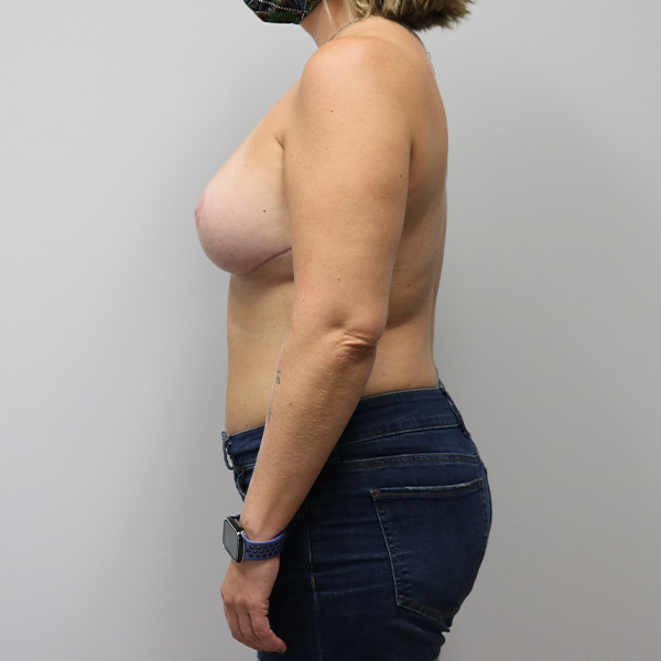 after breast lift with implants left view case 2621