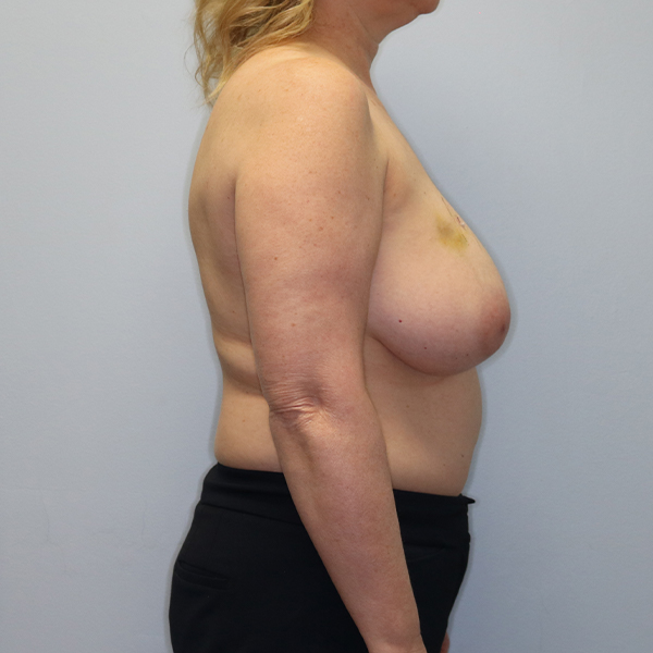 before breast reconstruction right side case 2598