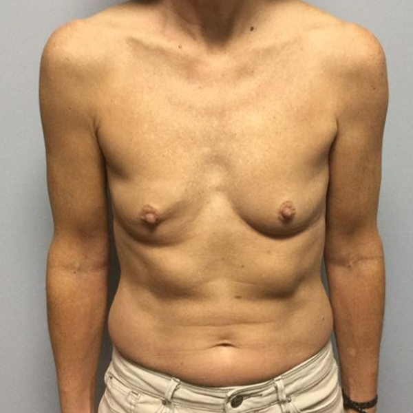 before breast reconstruction front view of female patient case 3194