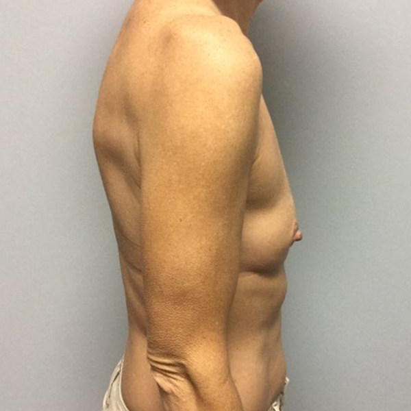 before breast reconstruction right view of female patient case 3194