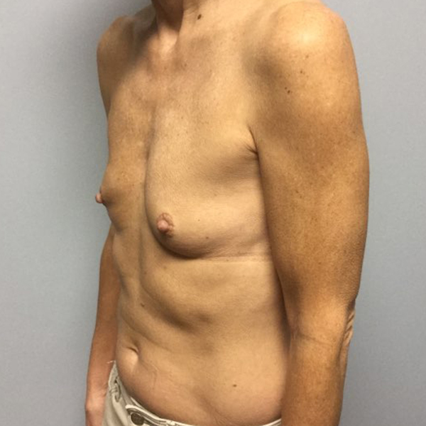 before breast reconstruction left angle view of female patient case 3194