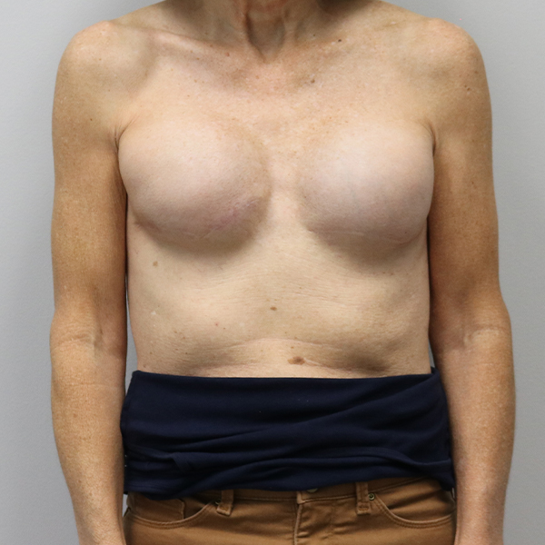 after breast reconstruction front view of female patient case 3194