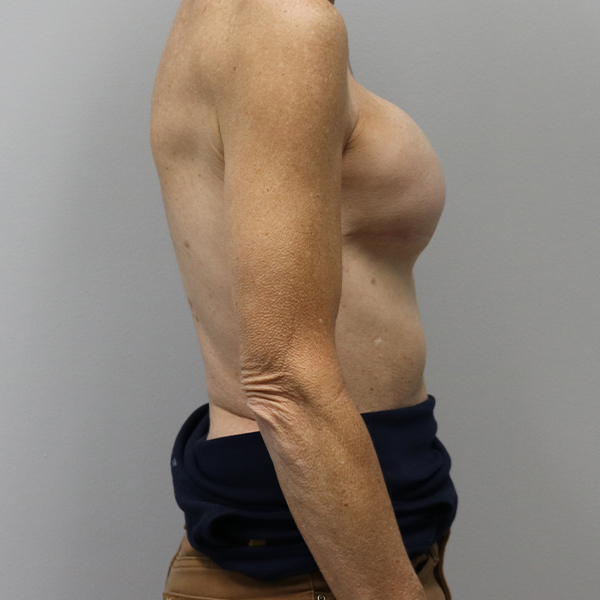 after breast reconstruction right view of female patient case 3194