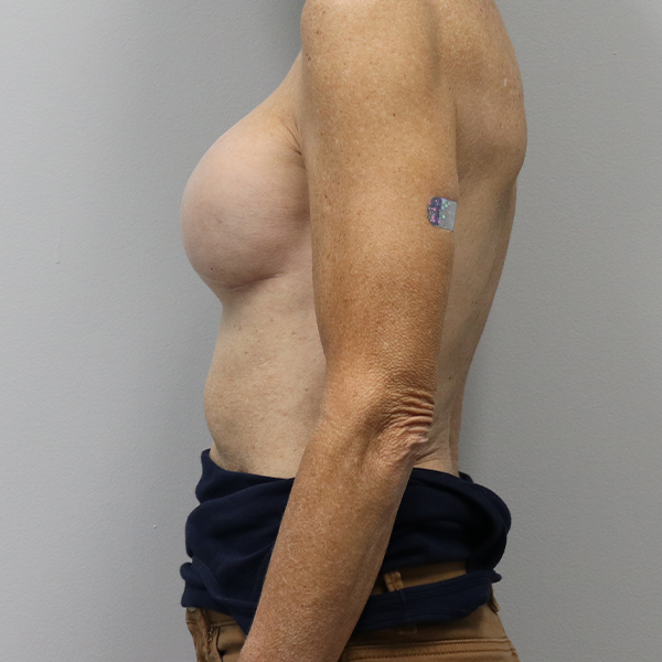 after breast reconstruction left view of female patient case 3194