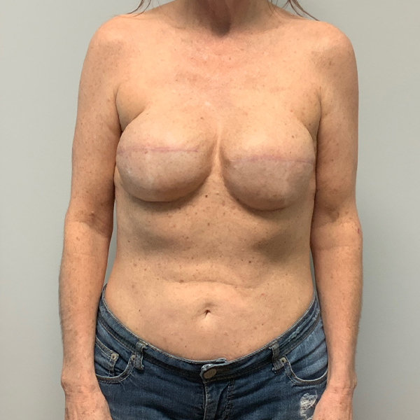 after breast reconstruction front view of female patient case 3205
