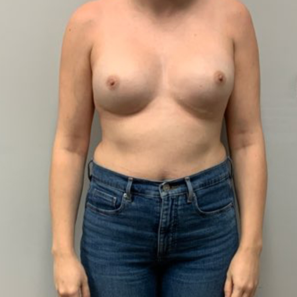 after breast reconstruction front view of female patient case 3216