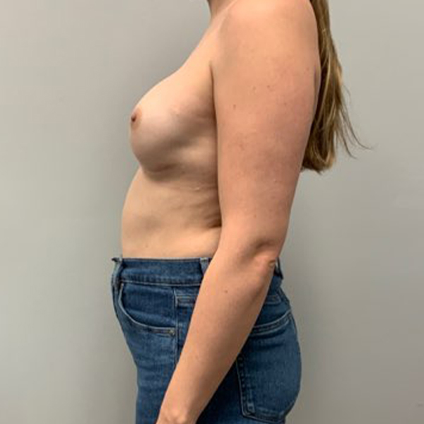 after breast reconstruction left view of female patient case 3216