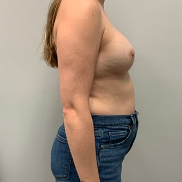 after breast reconstruction right view of female patient case 3216