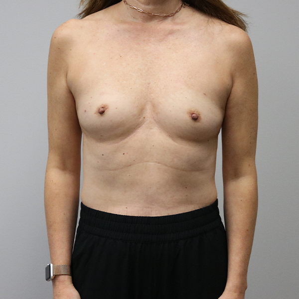 before breast reconstruction front view of female patient case 3249