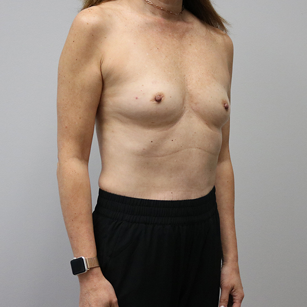 before breast reconstruction right angle view of female patient case 3249