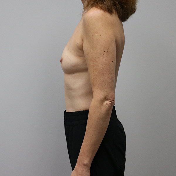 before breast reconstruction left view of female patient case 3249