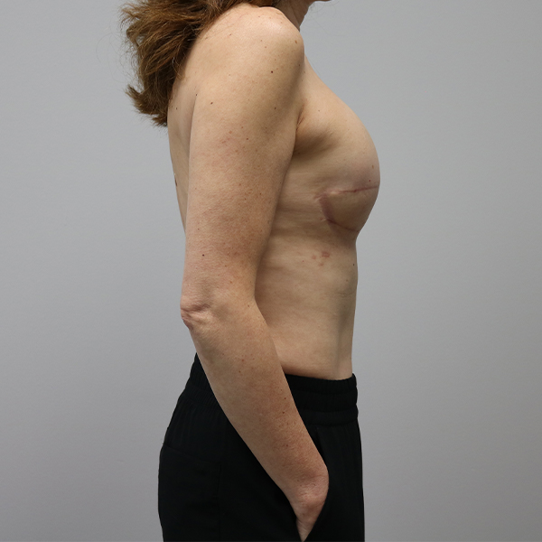 after breast reconstruction right view of female patient case 3249