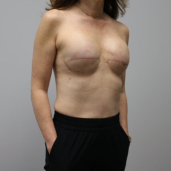 after breast reconstruction right angle view of female patient case 3249