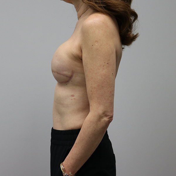 after breast reconstruction left view of female patient case 3249
