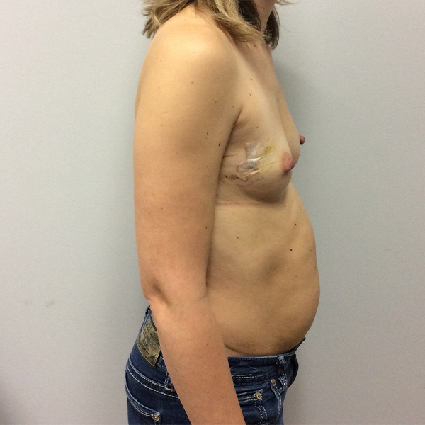 before breast reconstruction right view of female patient case 3271