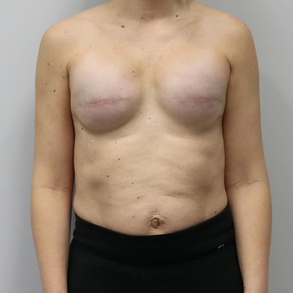 after breast reconstruction front view of female patient case 3271