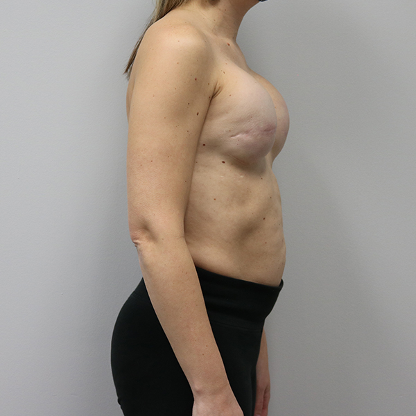 after breast reconstruction right view of female patient case 3271