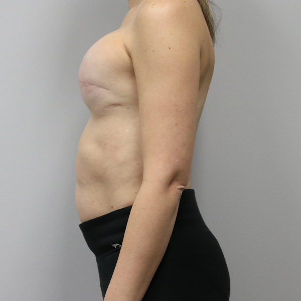 after breast reconstruction left view of female patient case 3271