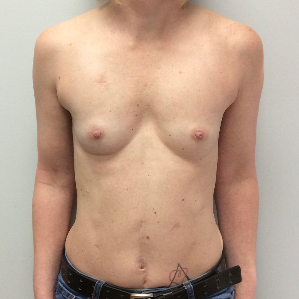 before breast reconstruction front view of female patient case 3282