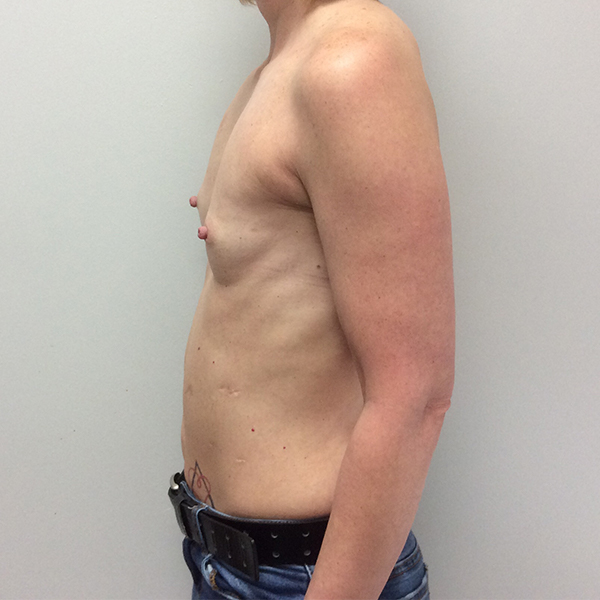 before breast reconstruction left view of female patient case 3282