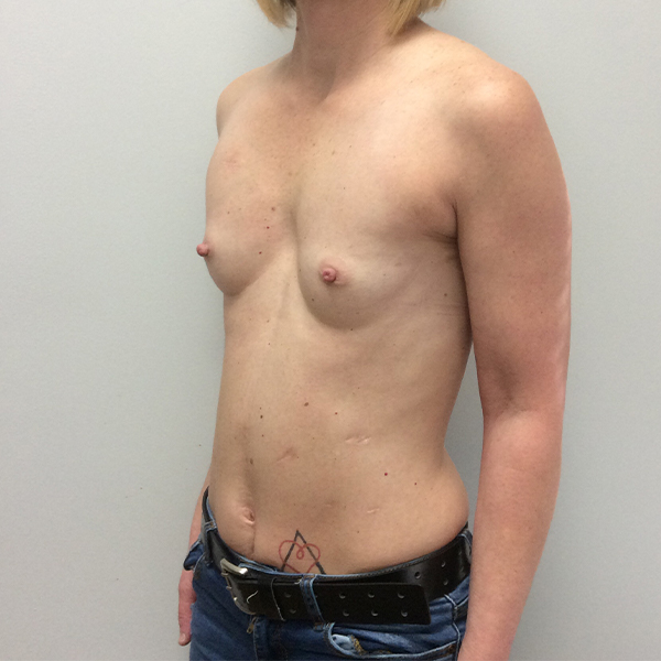 before breast reconstruction left angle view of female patient case 3282