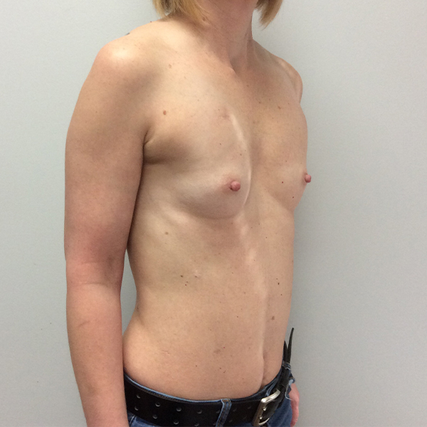 before breast reconstruction right angle view of female patient case 3282