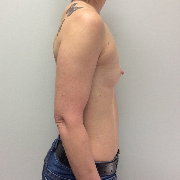 before breast reconstruction right view of female patient case 3282