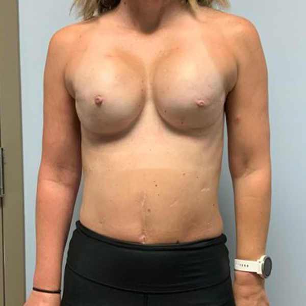after breast reconstruction front view of female patient case 3282