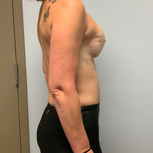 after breast reconstruction right angle view of female patient case 3282