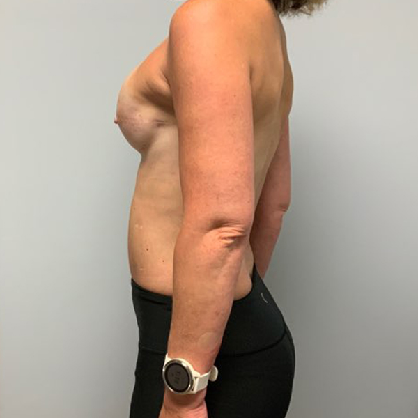 after breast reconstruction left view of female patient case 3282