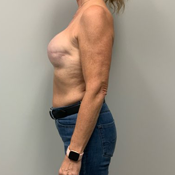 after breast reconstruction left view of female patient case 3293