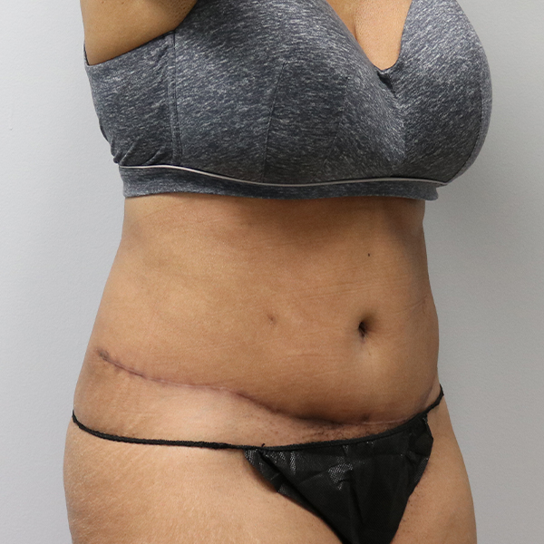 after tummy tuck right angle of female patient case 2643