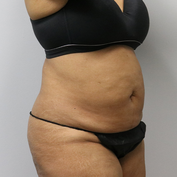 before tummy tuck right angle of female patient case 2643