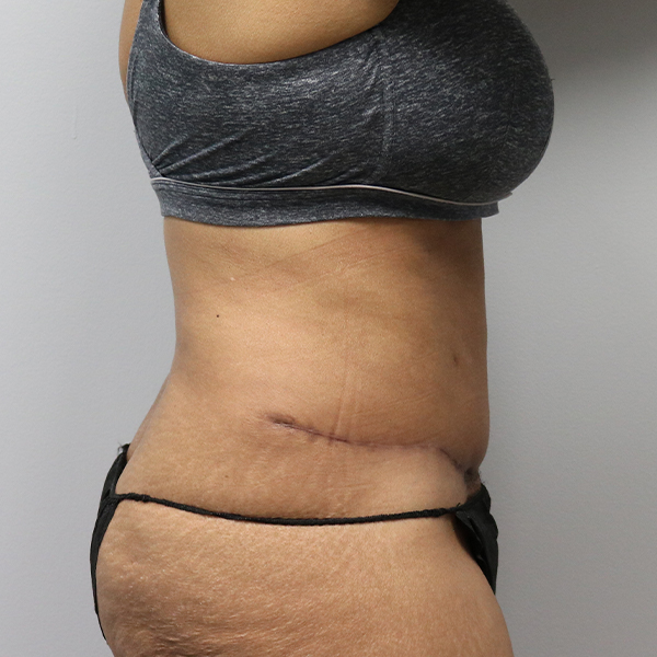 after tummy tuck right view of female patient case 2643
