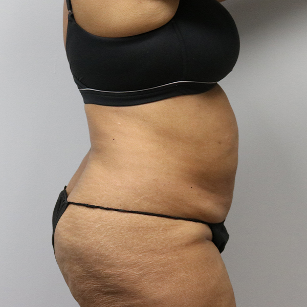 before tummy tuck right view of female patient case 2643