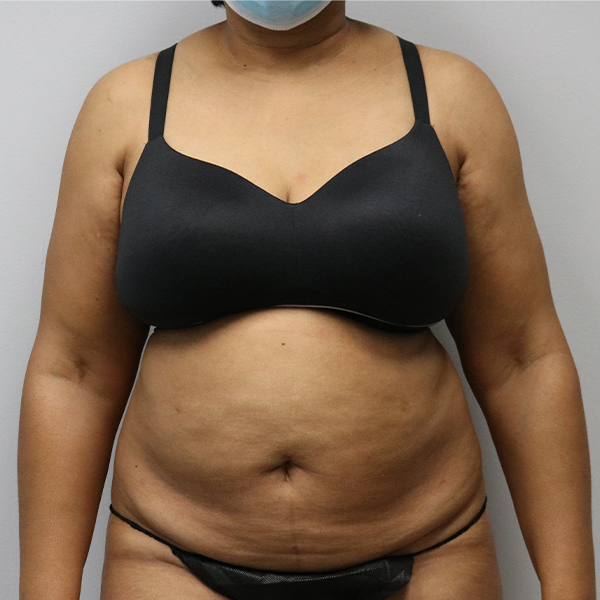 before tummy tuck front view female patient case 26643