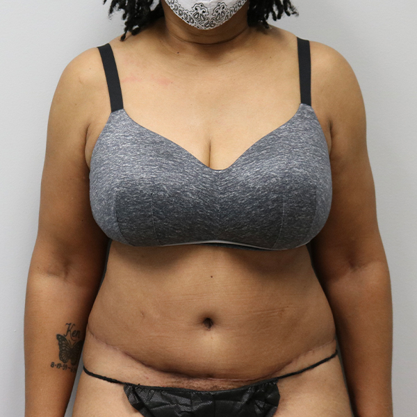 after tummy tuck front view female patient case 2643