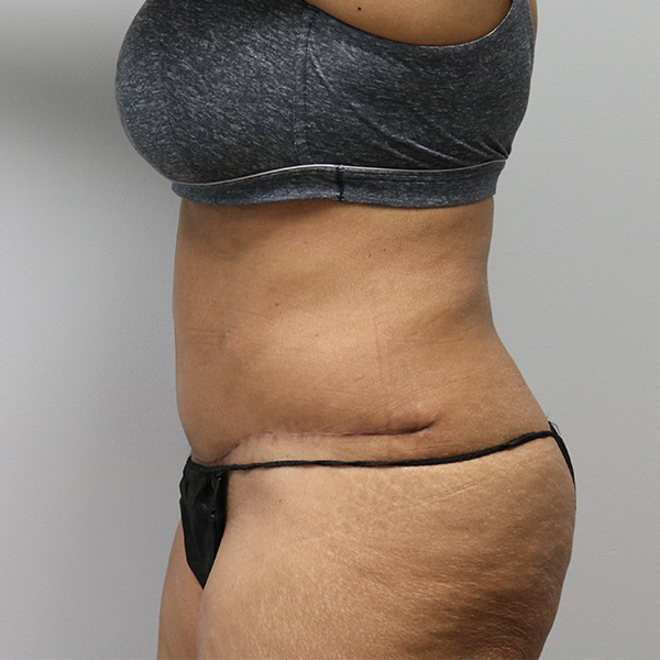 after tummy tuck left view of female patient case 2643