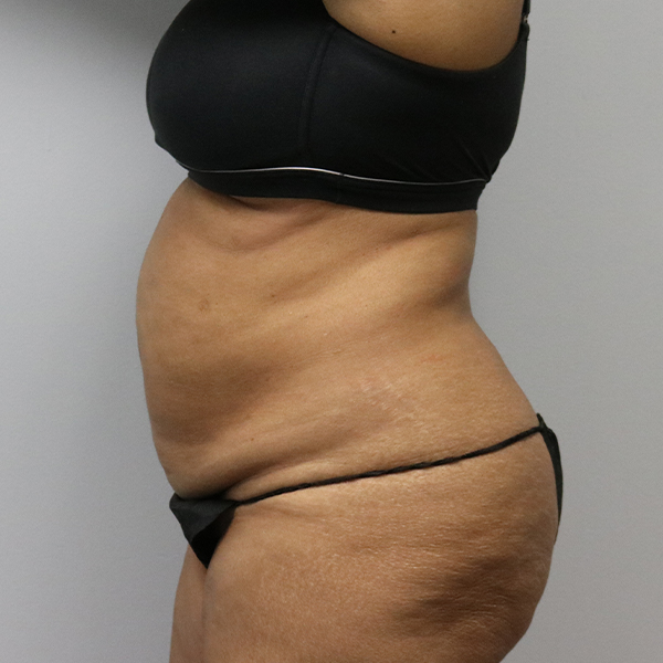 before tummy tuck left view of female patient case 2643