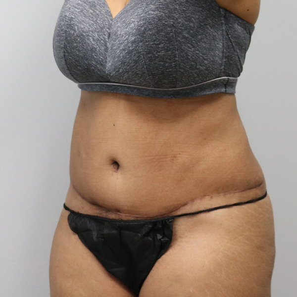 after tummy tuck right left view female patient case 2643