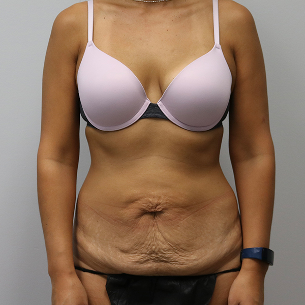 before tummy tuck front view of female patient case 2675