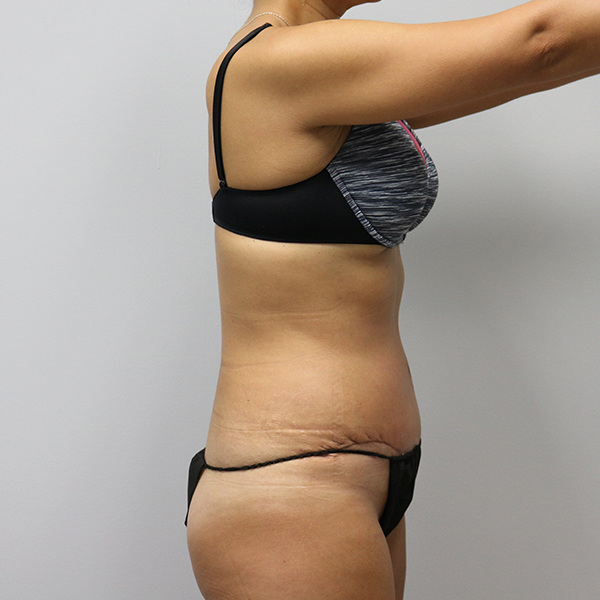 after tummy tuck right view of female patient case 2675