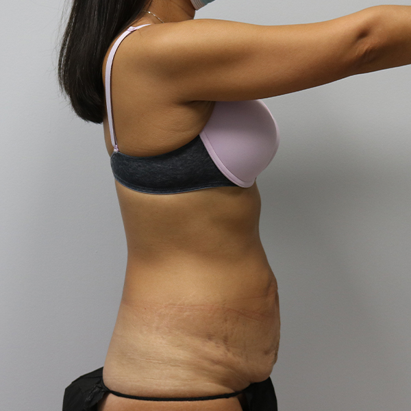 before tummy tuck right view of female patient case 2675