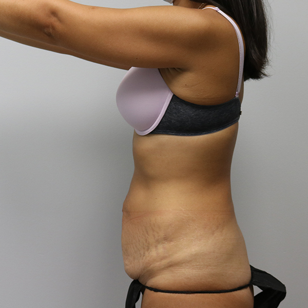 before tummy tuck left view of female patient case 2675