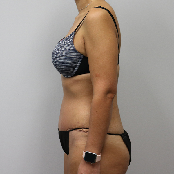 after tummy tuck left view of female patient case 2675